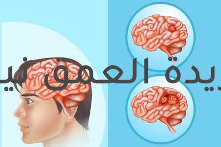 شلل دماغي