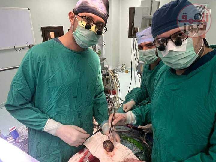 فريق طبى بجامعة أسيوط ينجح فى إنقاذ حياة سيدة أربعينية باستئصال ورم ضخم من القلب العمق نيوز